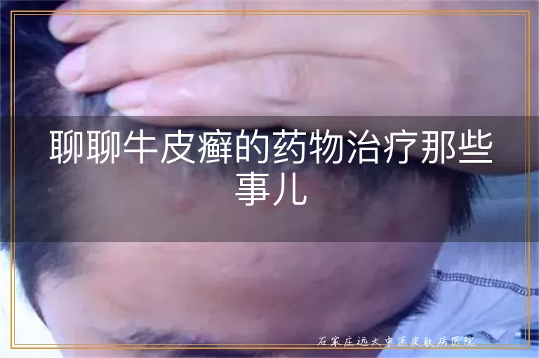 聊聊牛皮癣的药物治疗那些事儿