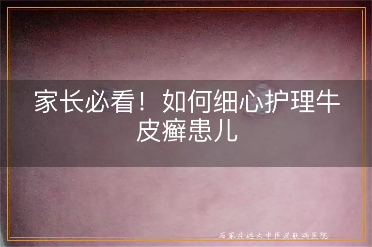 家长必看！如何细心护理牛皮癣患儿