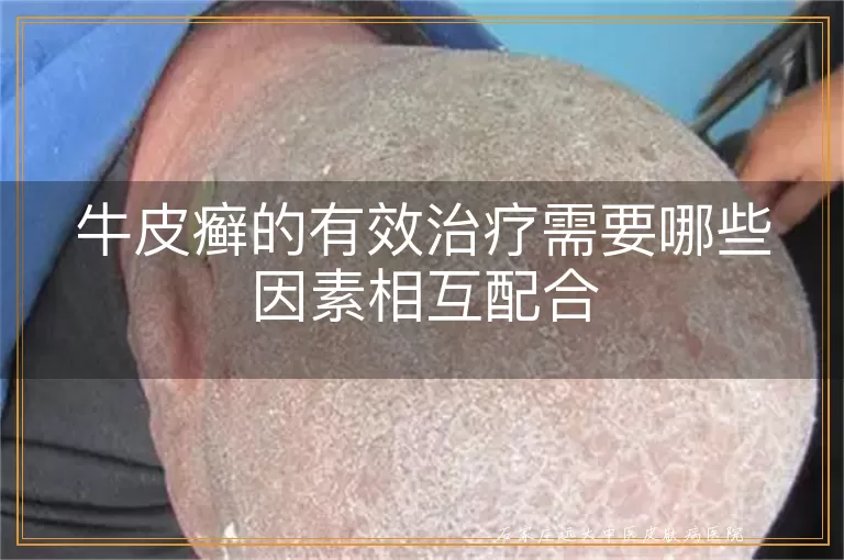 牛皮癣的有效治疗需要哪些因素相互配合