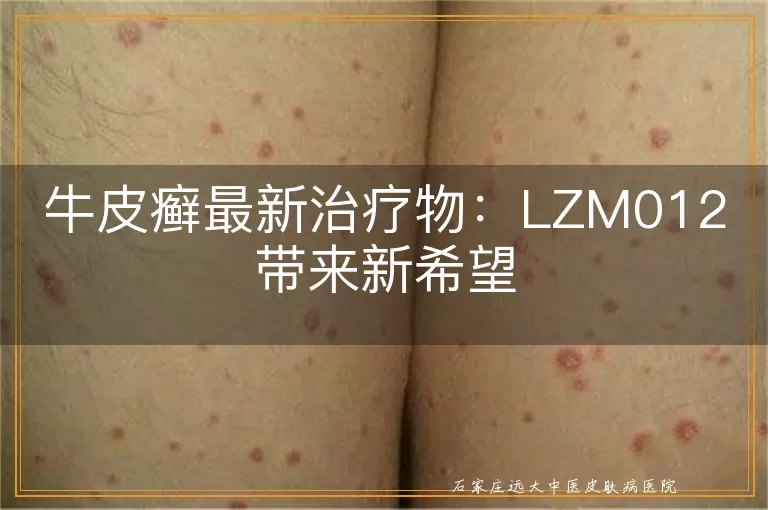 牛皮癣最新治疗物：LZM012带来新希望