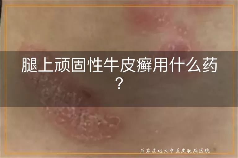 腿上顽固性牛皮癣用什么药？
