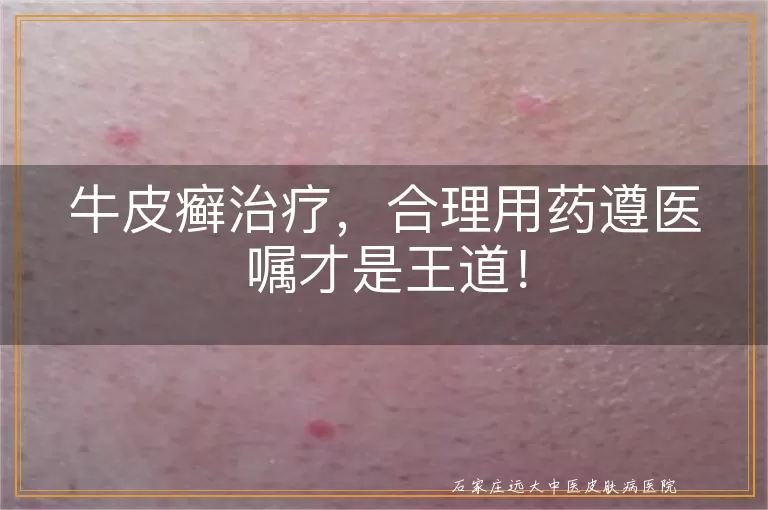 牛皮癣治疗，合理用药遵医嘱才是王道！