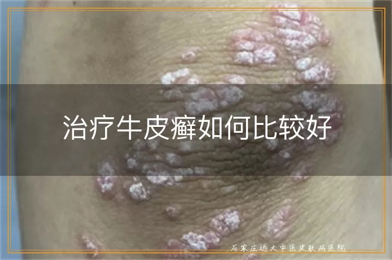 治疗牛皮癣如何比较好