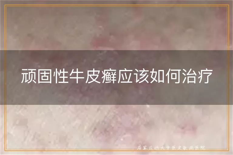 顽固性牛皮癣应该如何治疗