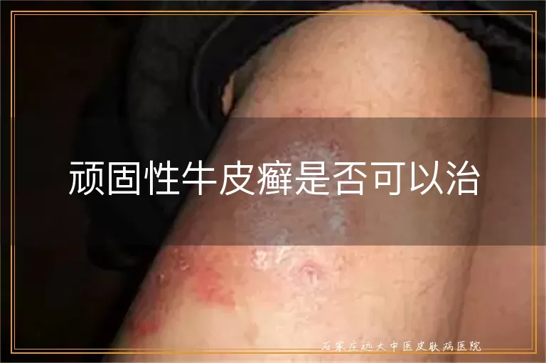 顽固性牛皮癣是否可以治