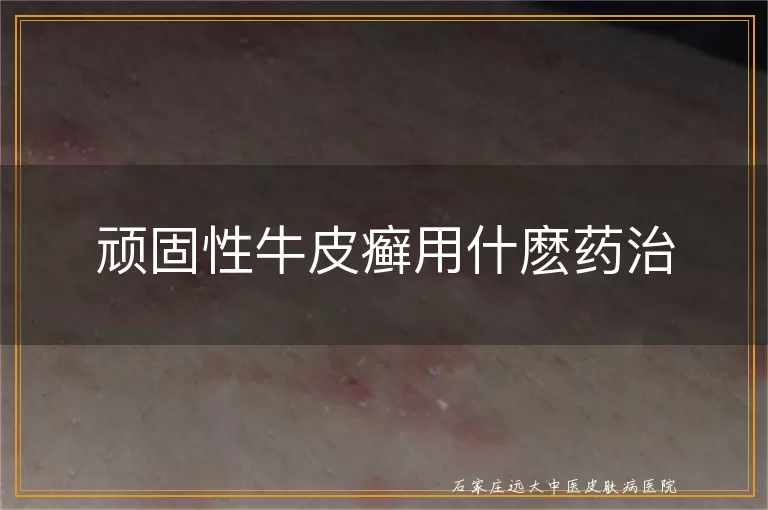 顽固性牛皮癣用什麽药治