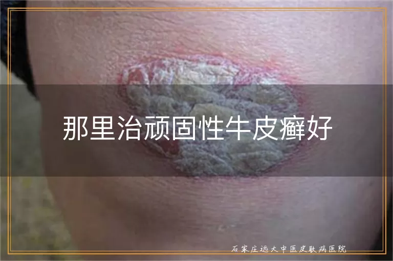那里治顽固性牛皮癣好