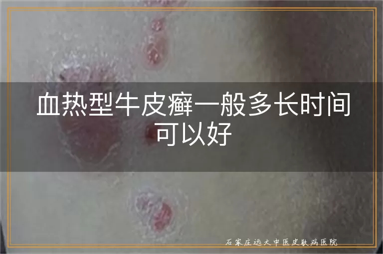 血热型牛皮癣一般多长时间可以好