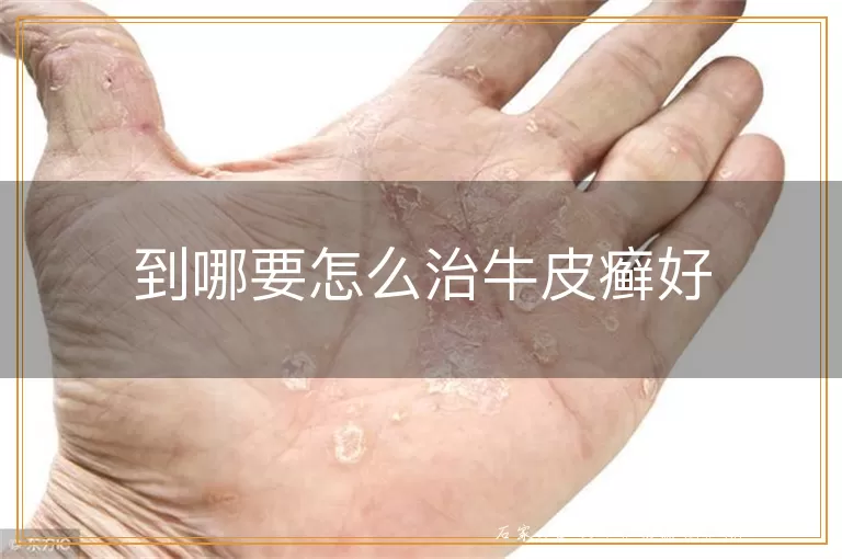 到哪要怎么治牛皮癣好