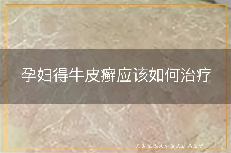 孕妇得牛皮癣应该如何治疗
