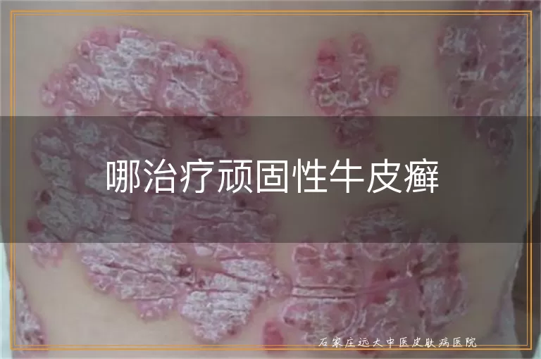 哪治疗顽固性牛皮癣