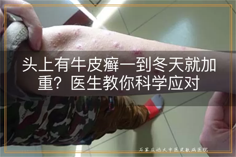 头上有牛皮癣一到冬天就加重？医生教你科学应对