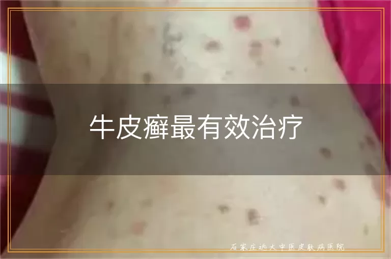 牛皮癣最有效治疗