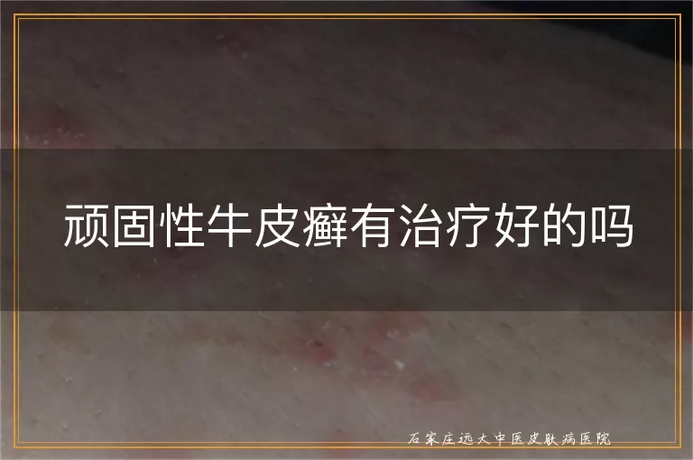 顽固性牛皮癣有治疗好的吗