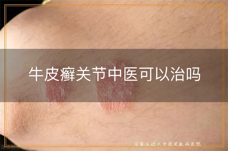 牛皮癣关节中医可以治吗