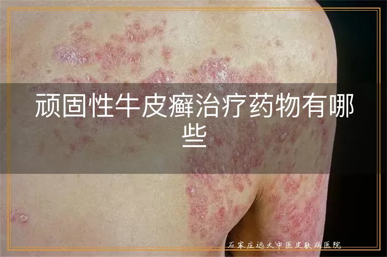 顽固性牛皮癣治疗药物有哪些