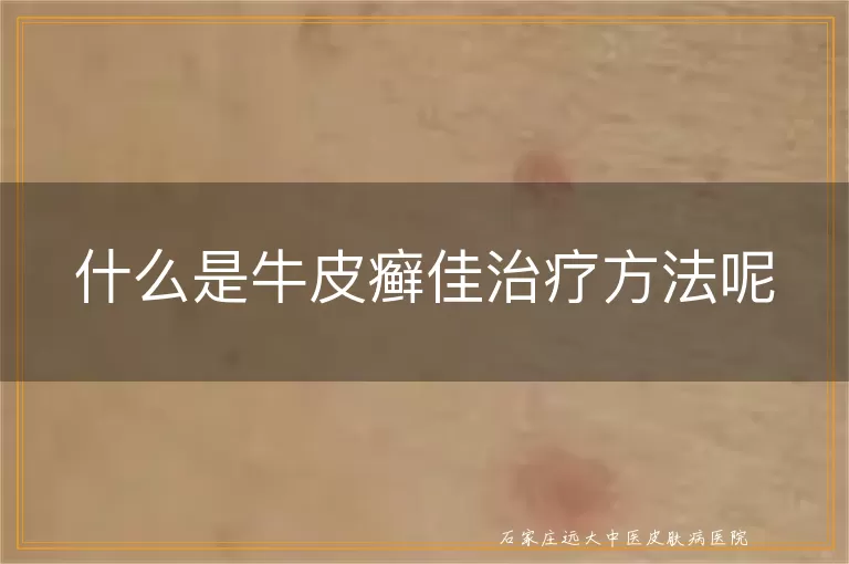 什么是牛皮癣佳治疗方法呢