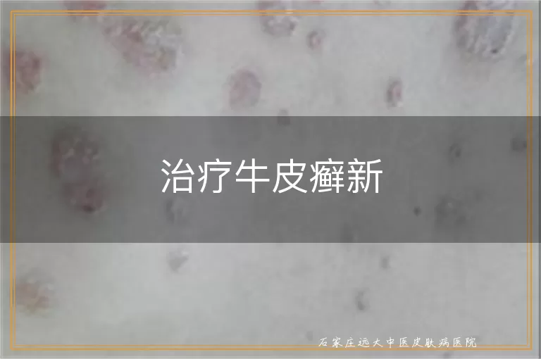 治疗牛皮癣新