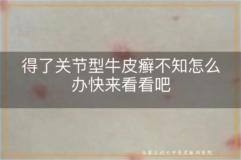 得了关节型牛皮癣不知怎么办快来看看吧