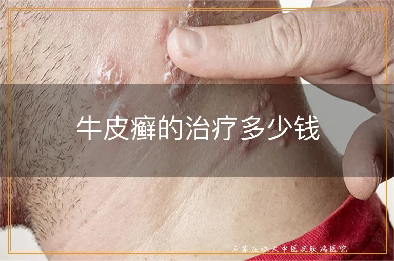 牛皮癣的治疗多少钱
