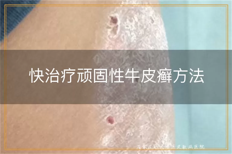 快治疗顽固性牛皮癣方法