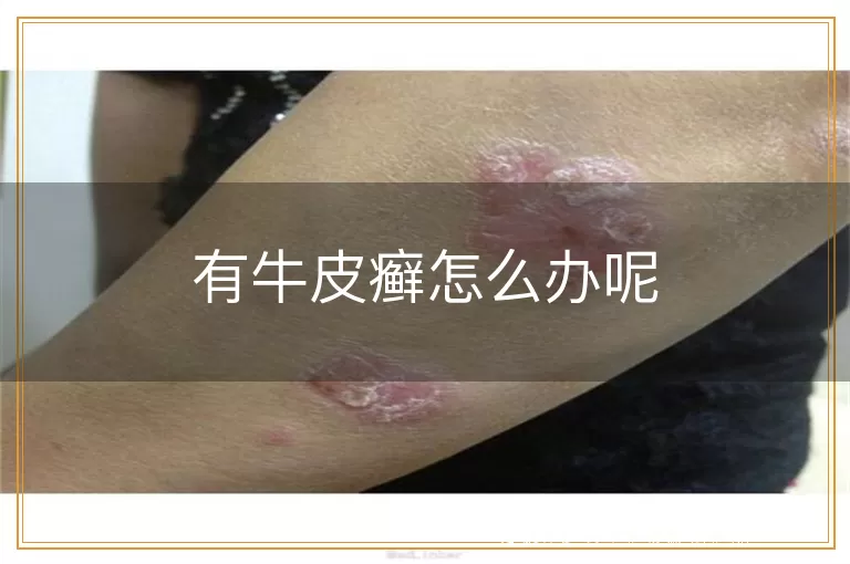 有牛皮癣怎么办呢