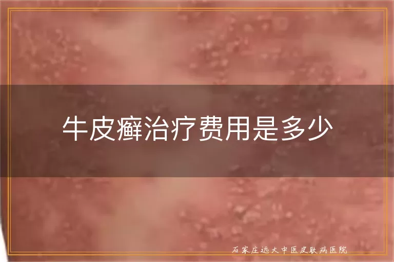 牛皮癣治疗费用是多少