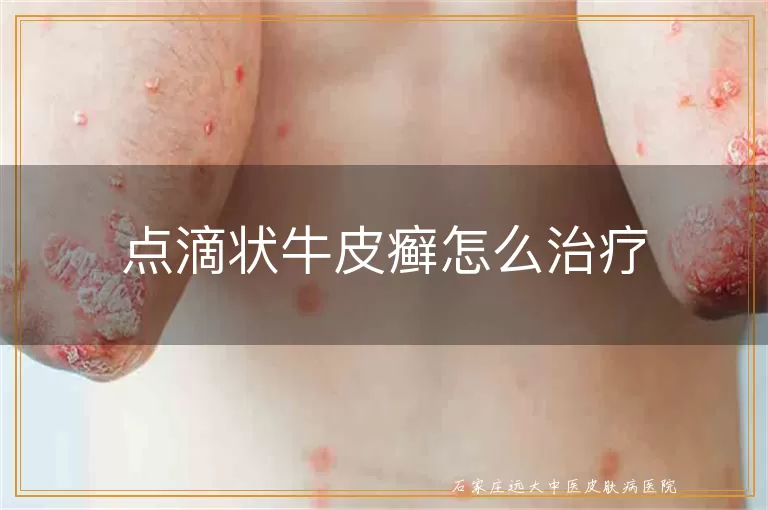 点滴状牛皮癣怎么治疗