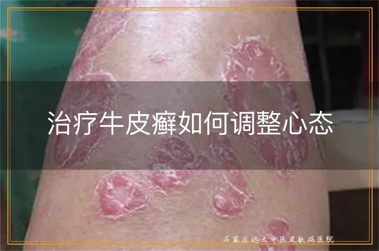 治疗牛皮癣如何调整心态