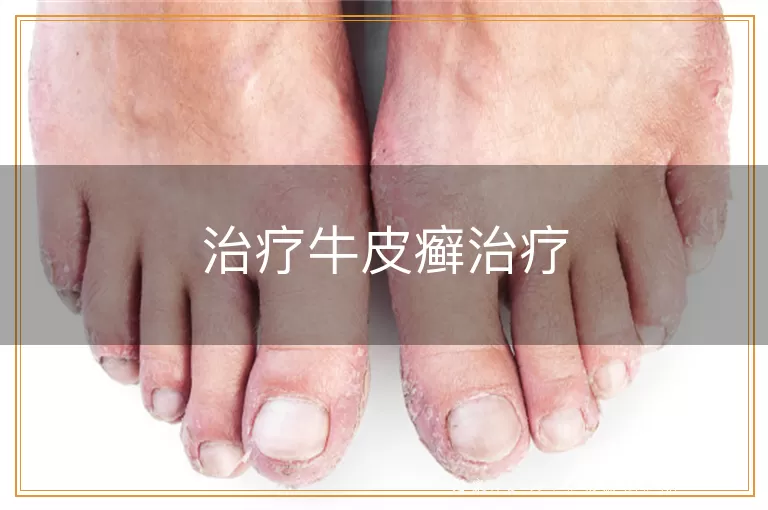 治疗牛皮癣治疗