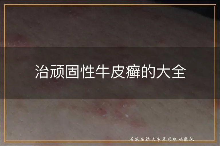 治顽固性牛皮癣的大全