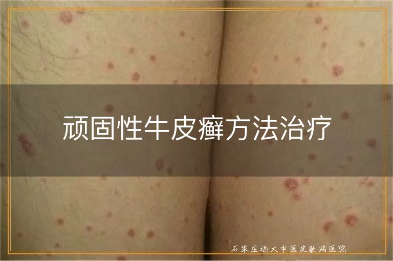 顽固性牛皮癣方法治疗