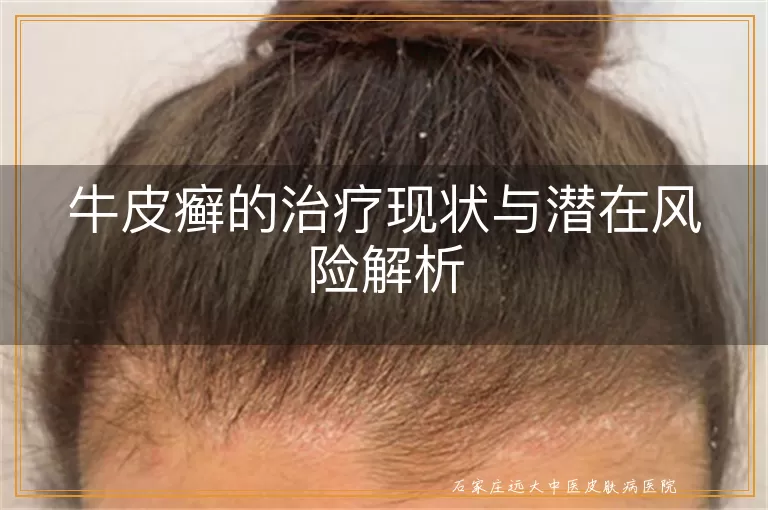 牛皮癣的治疗现状与潜在风险解析