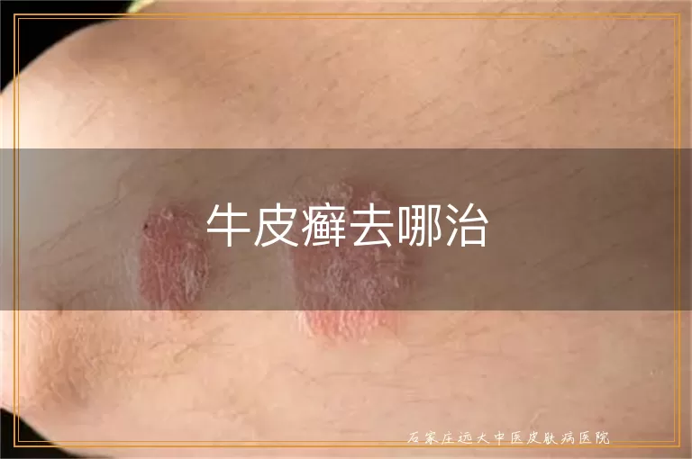 牛皮癣去哪治