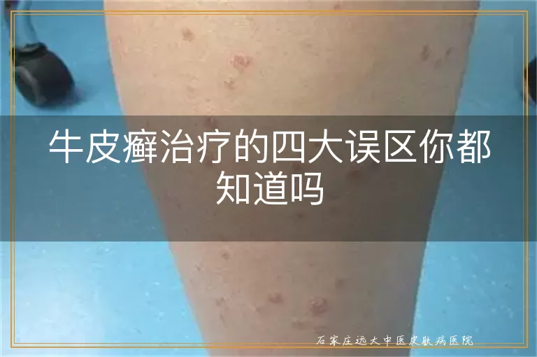 牛皮癣治疗的四大误区你都知道吗