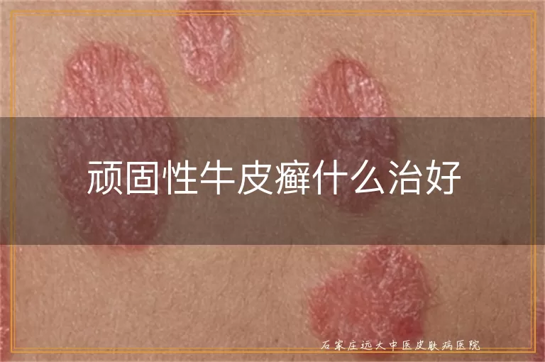 顽固性牛皮癣什么治好