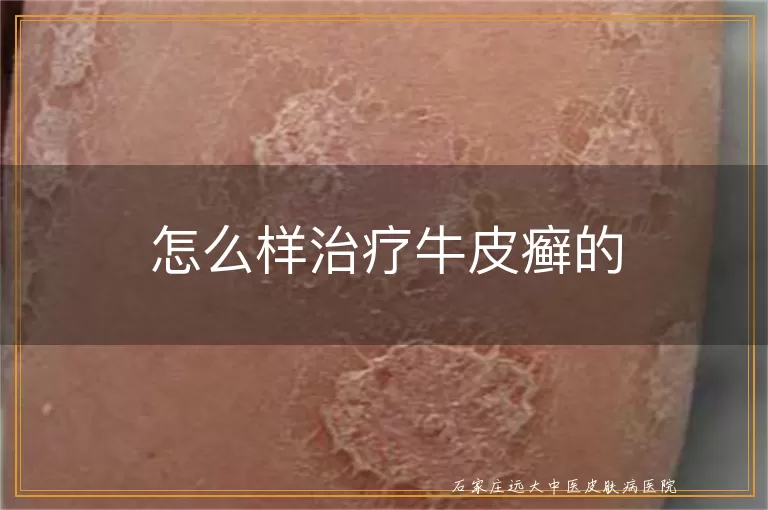 怎么样治疗牛皮癣的