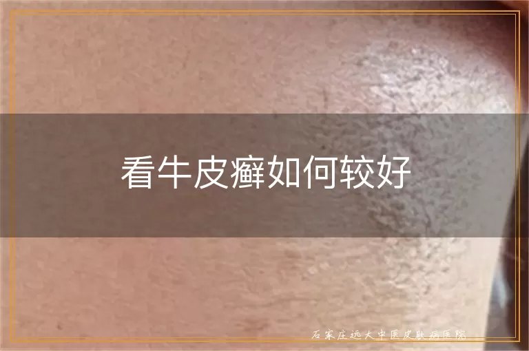 看牛皮癣如何较好