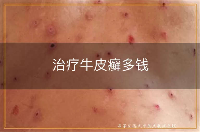 治疗牛皮癣多钱