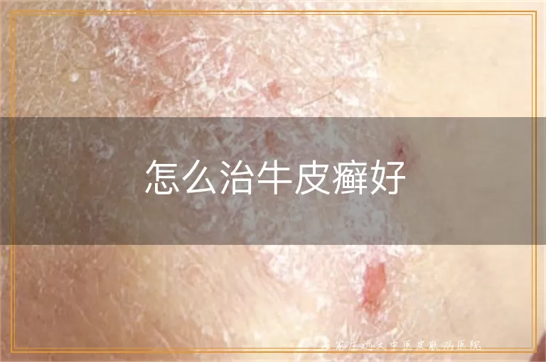 怎么治牛皮癣好
