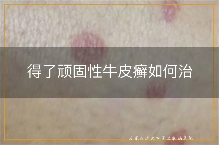 得了顽固性牛皮癣如何治