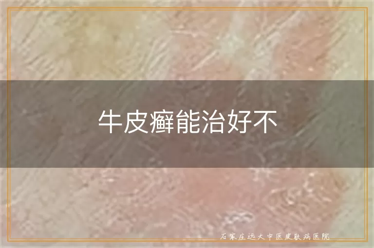 牛皮癣能治好不