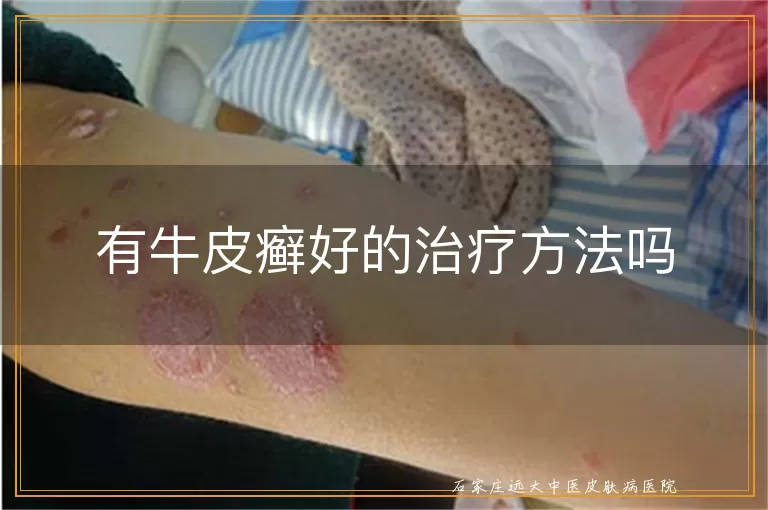 有牛皮癣好的治疗方法吗