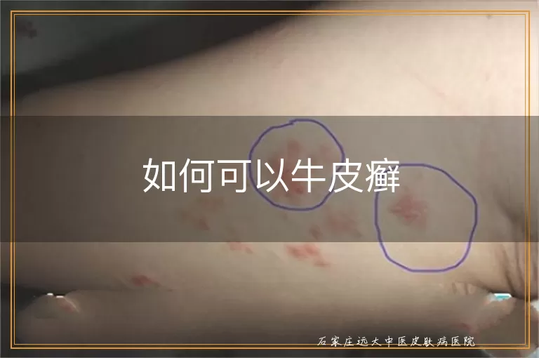 如何可以牛皮癣