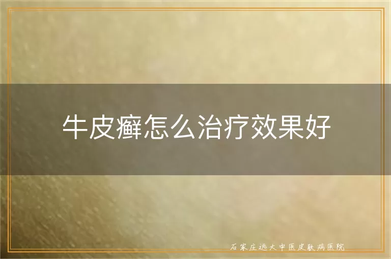牛皮癣怎么治疗效果好