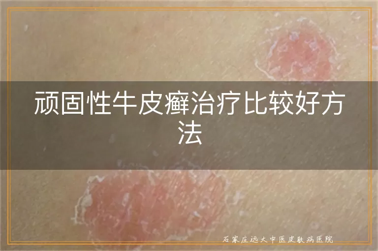 顽固性牛皮癣治疗比较好方法
