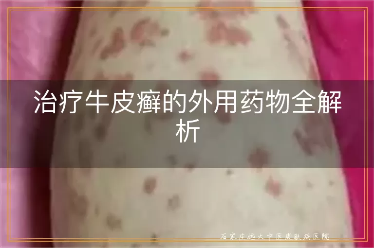治疗牛皮癣的外用药物全解析