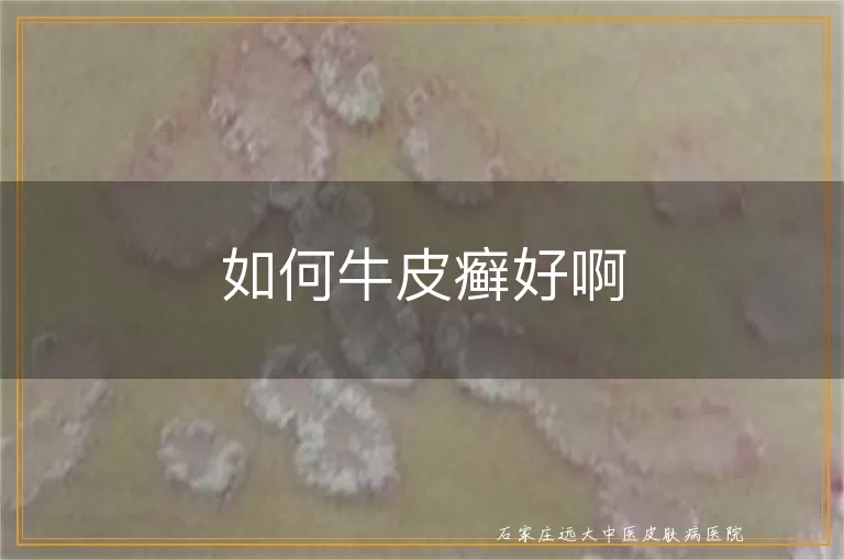 如何牛皮癣好啊