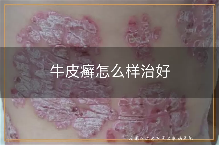 牛皮癣怎么样治好