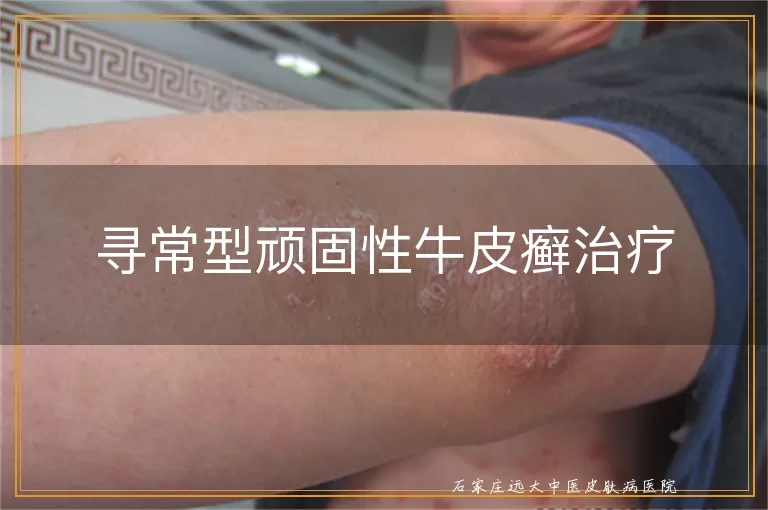 寻常型顽固性牛皮癣治疗